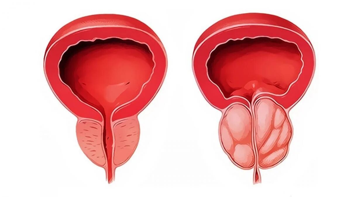 Увеличение предстательной железы. Простата это предстательная