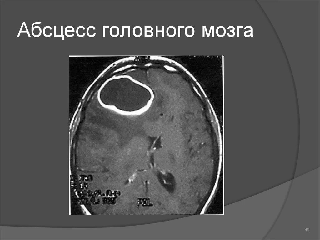 Абсцесс мозга. Амебный абсцесс головного мозга. Абсцесс головного мозга этиология. Абсцесс головного мозга клиника. Риногенный абсцесс головного мозга.