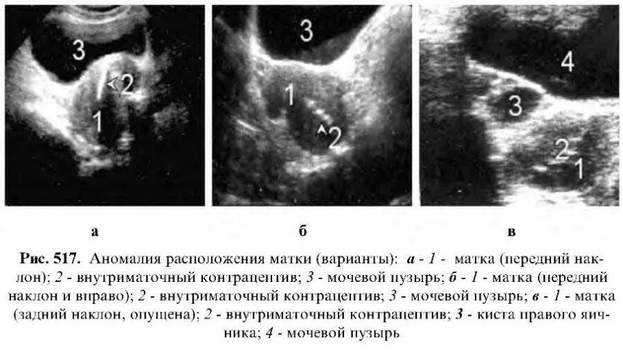 Положение матки на УЗИ. Расположение матки на УЗИ. Отклонение матки вправо. Матка отклонена влево на УЗИ. Не видна матка на узи