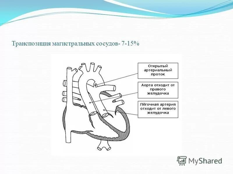 транспозиция магистральных сосудов у детей гемодинамика. порок сердца транспозиция магистральных сосудов. транспозиция магистральных сосудов гемодинамика.