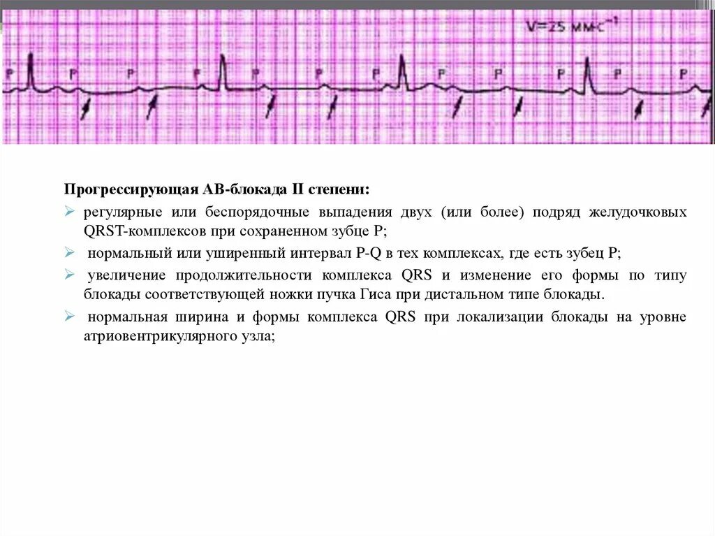 Блокада на первом. АВ блокада 1 степени на ЭКГ У детей. АВ блокада 2 степени жалобы. ЭКГ при АВ блокаде 1 степени. Механизм развития АВ блокады 3 степени.