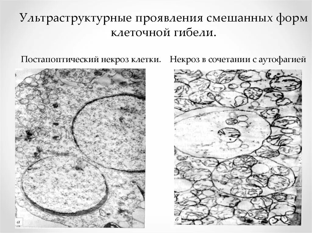 Микроскопические изменения в клетках. Ультраструктура клетки. Ультраструктурная патология клетки. Ультраструктурные изменения при некрозе. Ультраструктурные признаки некроза.