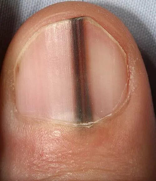 Вертикальные полоски на ногтях причины. Подноктевавая меланома.