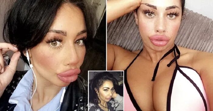 стефани мюлик. накаченные губы до и после. накаченные силиконом губы. минетчицы с силиконовыми губами. силиконовые губы.