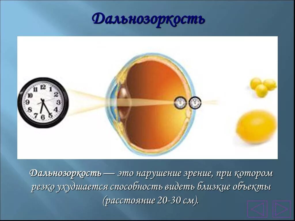 Минус и плюс в зрении. Дальнозоркость презентация. Дальнозоркость + или -. Дальнозоркость это плюс или минус. Зрение дальнозоркость плюс или минус.