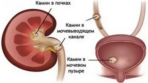 Цистолитиаз