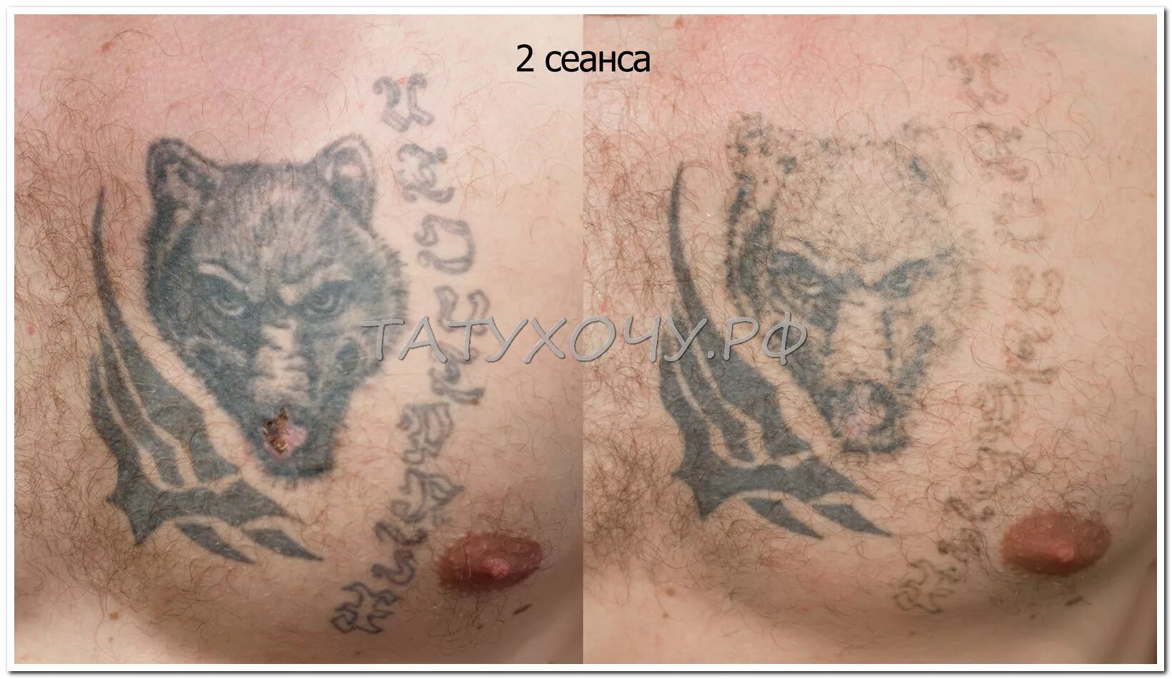 удаление тату тула