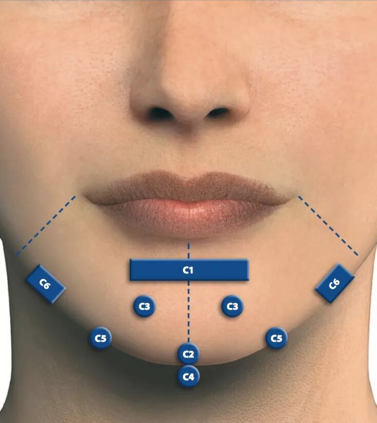 Как колоть филлер. Точки введения филлеров на лице. Точки введения ботулотоксина в подбородок. Ботокс в подбородок точки. Точки введения ботокса в подбородок.