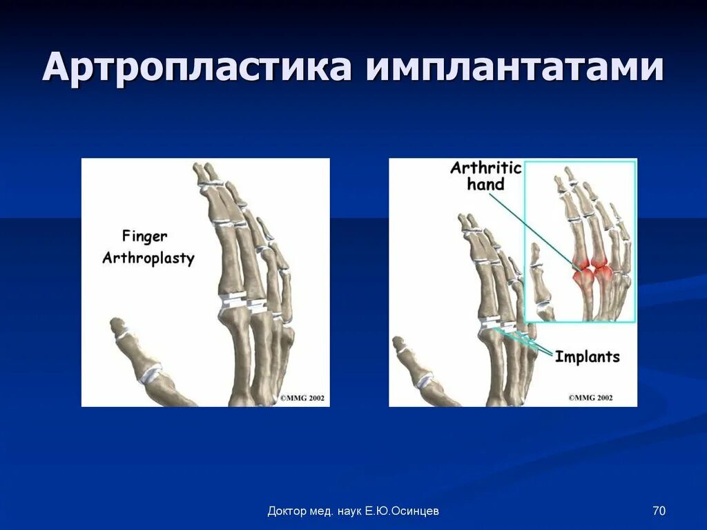 Артропластика техника. Принципы артропластики. Артропластика осложнения. Гнойные заболевания костей