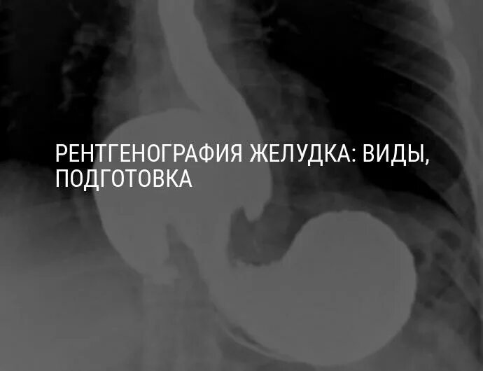 Снимки желудка с барием. Подготовка к рентгенографии желудка с барием.