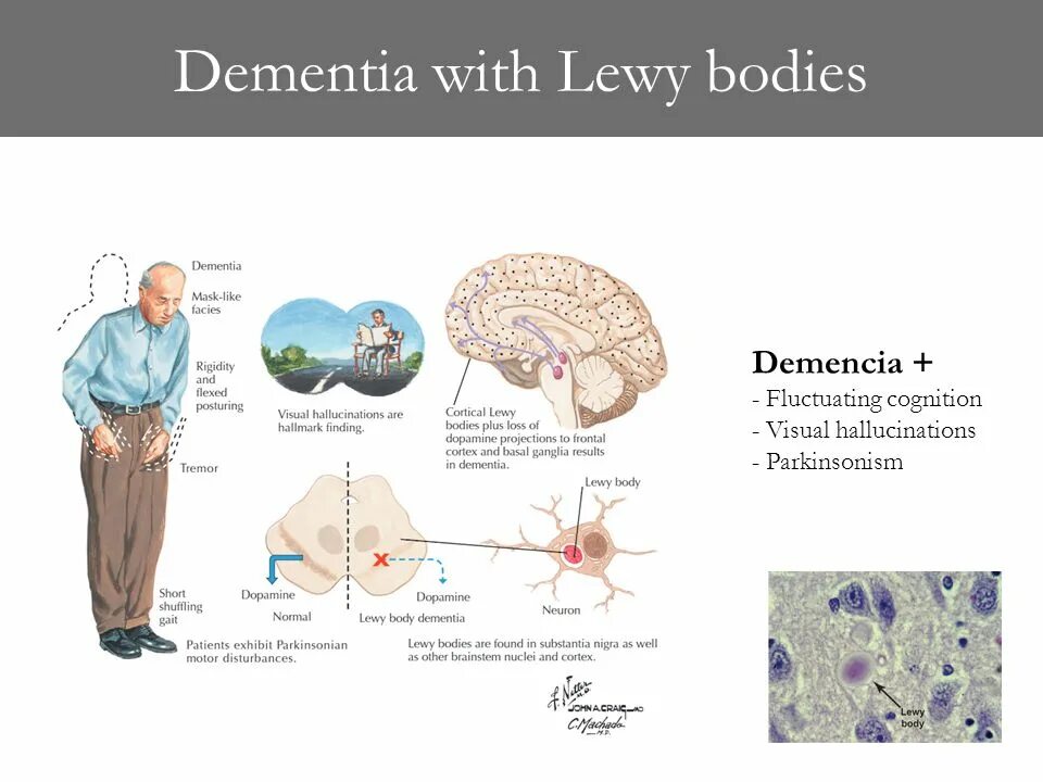 Деменция при паркинсоне. Тельца Леви при болезни Паркинсона. Деменция тельца Леви. Болезнь Паркинсона микроскопия. Деменция с тельцами Леви мозг.