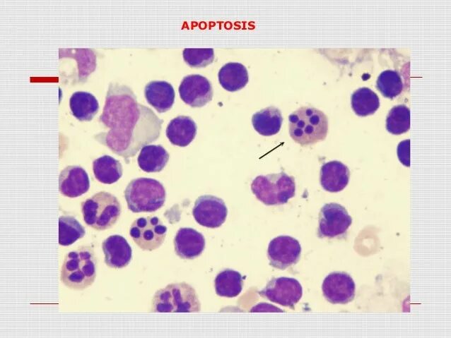 Кариопикноз это. Кариорексис кариолизис. Апоптоз кариорексис кариопикноз. Пикноз ядер нейтрофилов. Интерфаза, пикноз, кариорексис, кариолизис.