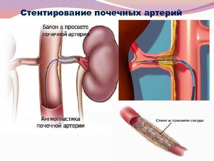 Стентирование сосудов почек. Стентирование почечной артерии. ТРАНСЛЮМИНАЛЬНАЯ баллонная ангиопластика почечной артерии. Ангиография тромбоз почечной артерии. Тромбоз почечной артерии