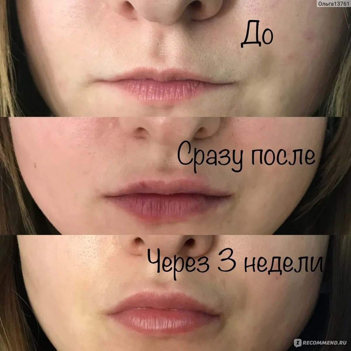 Губы после увеличения по дням. Зажившие губы после увеличения 1 мл. губы до и после увеличения зажившие. увеличение губ 1 мл до и после заживления. 1 мл в губах до и после заживления.