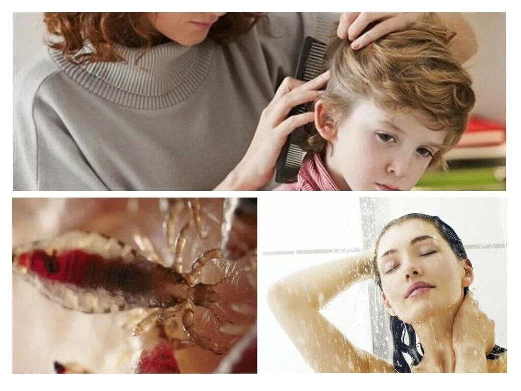 how to get rid of head lice in one day very easy - YouTube