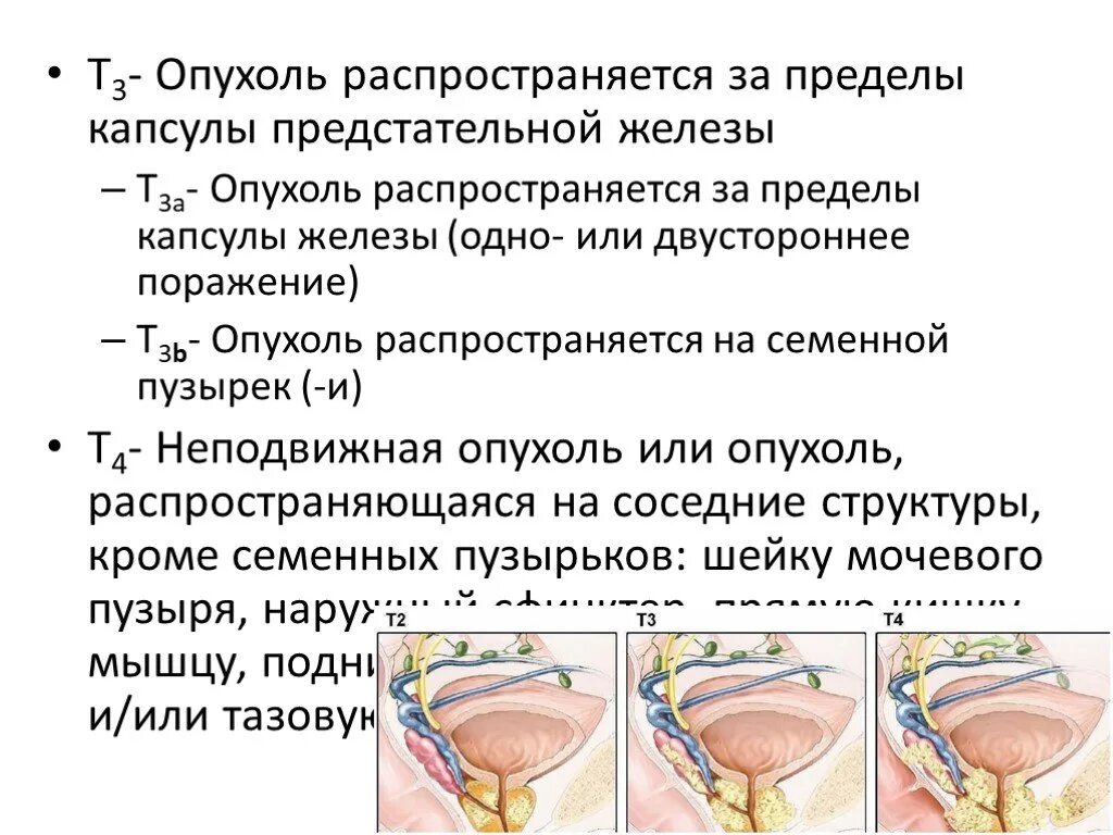 Капсула предстательной железы. Новообразование предстательной железы. Злокачественное новообразование предстательной железы. Объемное образование предстательной железы. Отёк предстательной железы.