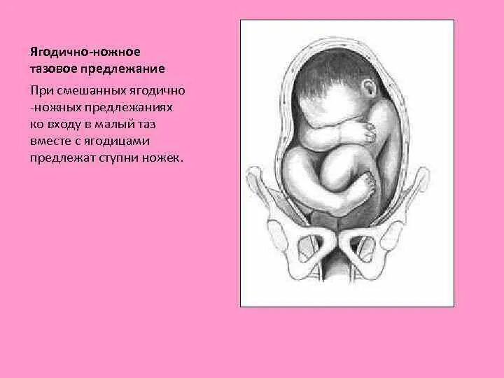 Тазовое предлежание мальчика. Смешанное ягодичное предлежание плода. Смешанное ягодичное предлежание плода роды. Смешанное тазовое предлежание плода. Тазовое предлежание смешанное ягодичное.