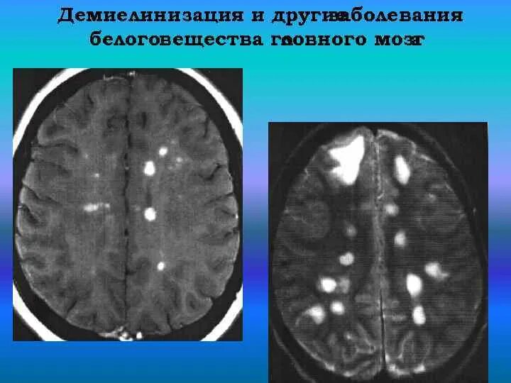 Очаги демиелинизации на мрт. Пальцы доусона при рассеянном склерозе на мрт. Кольцевидное накопление контраста селезёнки кт. Очаги при рс. Очаги демиелинизации при рассеянном склерозе.