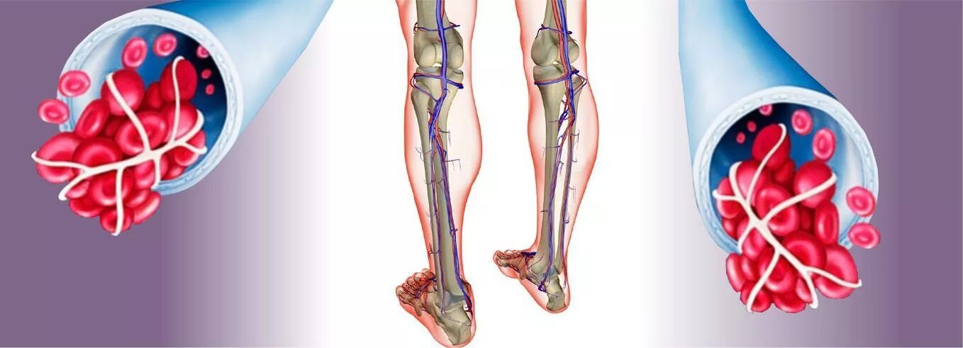 Заболевания артериальных сосудов. Флебит тромбофлебит флеботромбоз. Облитерирующий атеросклероз сосудов ног. Илеофеморальный венозный тромб. Тромбофлебит сосудов нижних конечностей.
