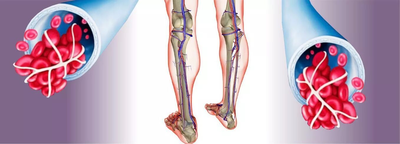 Флебит тромбофлебит флеботромбоз. Облитерирующий атеросклероз сосудов ног. Илеофеморальный венозный тромб. Тромбофлебит сосудов нижних конечностей. Как снизить тромбоз
