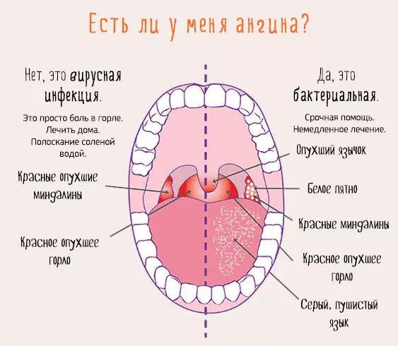 Как отличить вирусную. Горло при вирусной и бактериальной инфекции отличия. Отличие вирусной ангины от бактериальной у ребенка. Вирусная ангина от бактериальной. Ангинатвирусная или бактериальная.