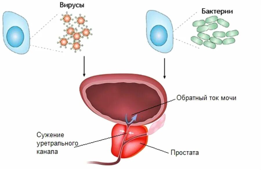 Воспалить простату. Хронический бактериальный простатит. Острый бактериальный простатит. Воспаление предстательной железы. Бактерицидный простатит.