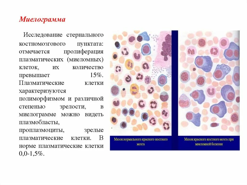 Костный мозг какие заболевания. Миелограмма плазматические клетки. Норма плазматических клеток в миелограмме. Миеломная болезнь плазматические клетки. Плазматические клетки в костном мозге.