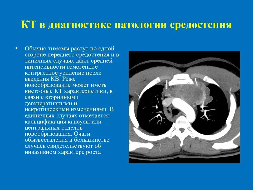 Можно ли кт. Кт грудной клетки сзади. Компьютерная томография средостения.