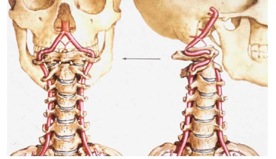 Изгиб вса. Вертебральный синдром позвоночной артерии. V4 позвоночной артерии. Извитый ход позвоночной артерии. Койлинг позвоночной артерии.
