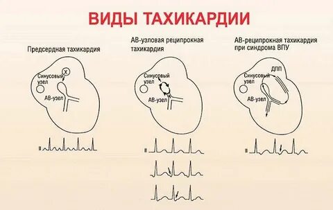 Сердцебиение побочный эффект