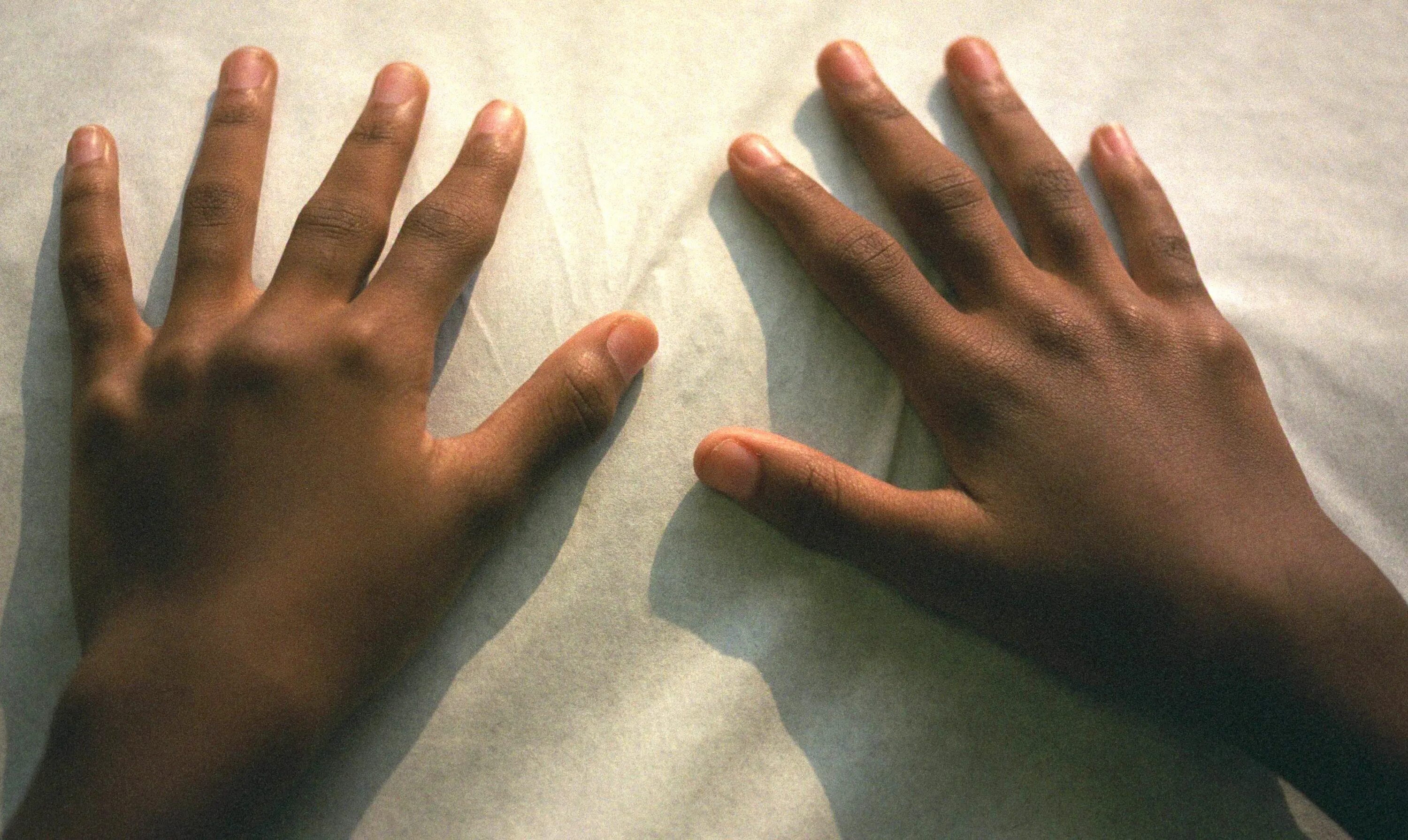 Ревматоидным артритом Рейно. Ювенильный ревматоидный артрит кистей рук. Ревматоидный артрит синдром Рейно. Подагра ревматоидный артрит кистей. Изменения кисти рук