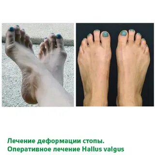 Лечение вальгусной деформации