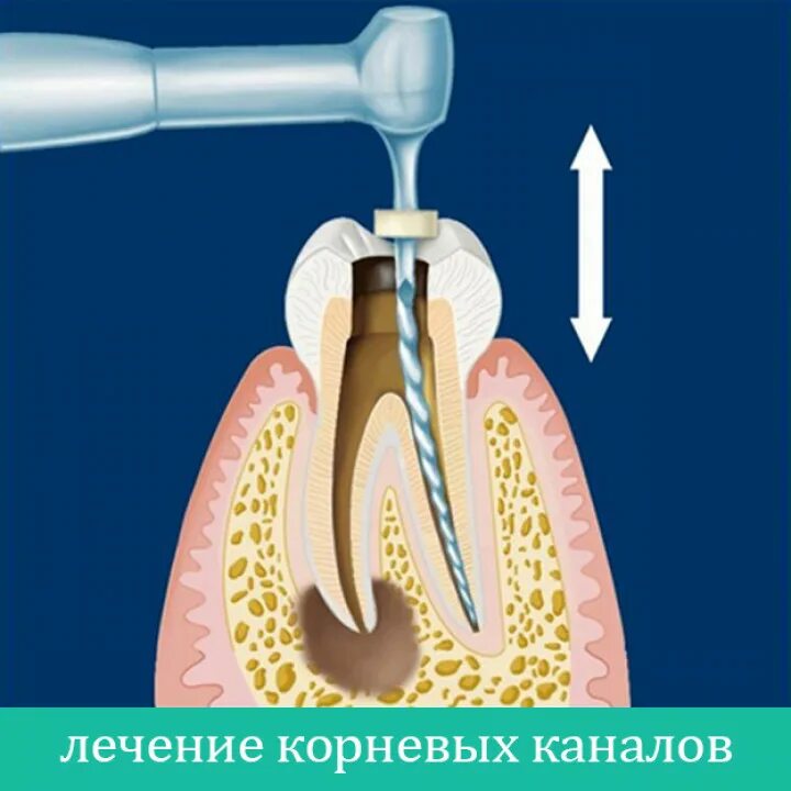 Прочистка каналов зуба