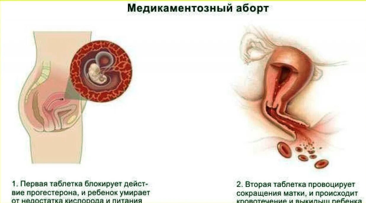 После медикаментозного прерывания можно забеременеть. Медикаментозный выкидыш. После медикаментозного прерывания беременности. Медикаментозное прерывание беременности на ранних сроках. Медикаментозный аборт картинки.