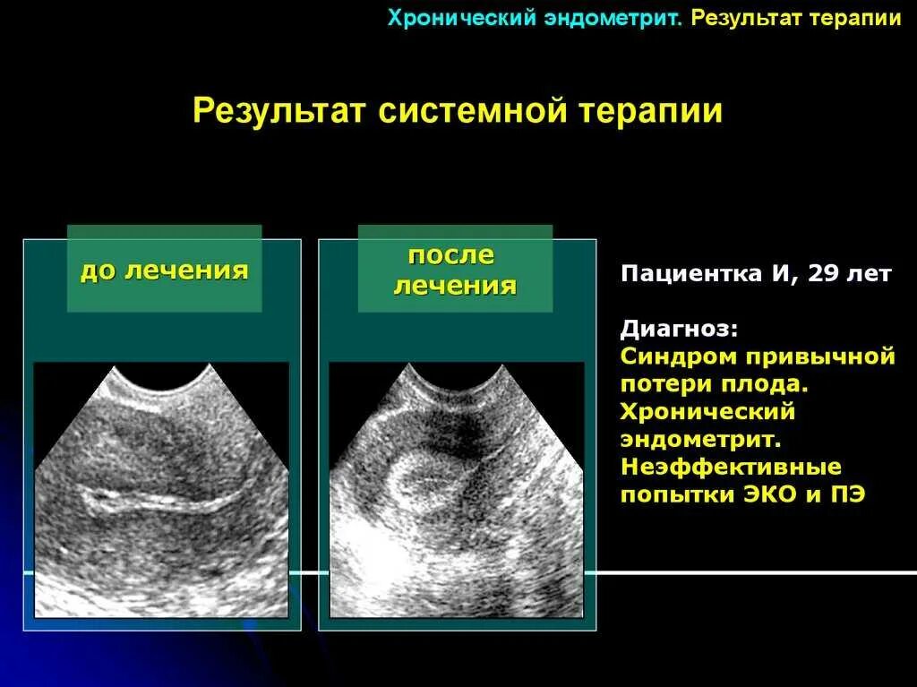 Лечение эндометрия форум