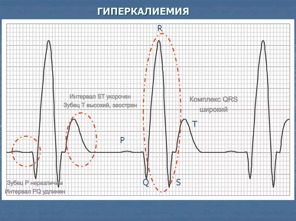 Мв на экг. ЭКГ при гиперкалиемии. Зубец т на ЭКГ при гиперкалиемии. Признаки гиперкалиемии на ЭКГ. Зубец т ЭКГ гипокалиемия.