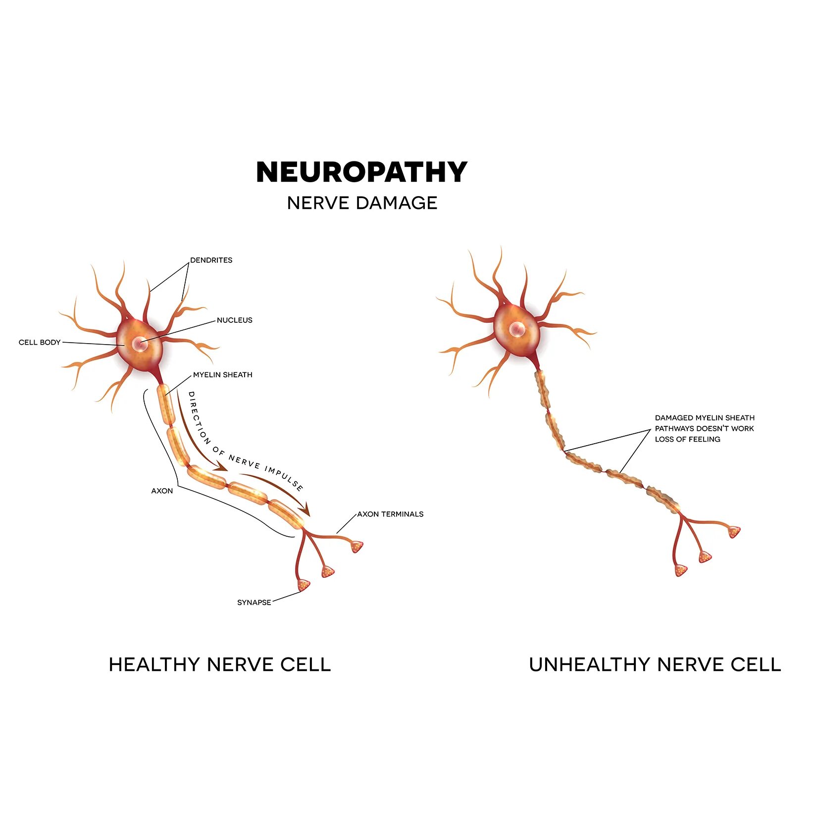 Короткие аксоны сильно ветвятся. Нейроны головного мозга строение. Нервная клетка. Нервные клетки восстанавливаются. Поврежденный Нейрон.