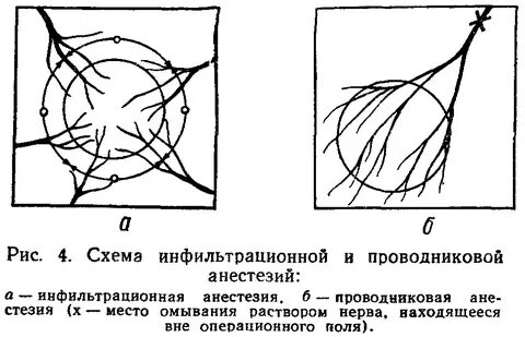 Анестезия инфильтрационная проводниковая