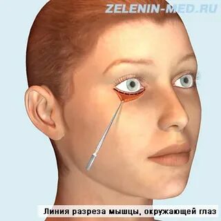 Операция по разрезу глаз