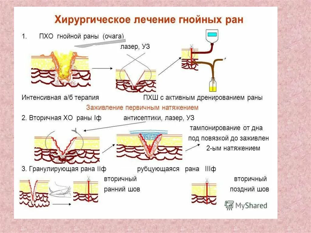 Показания к вторичной хирургической обработке РАН. Вторичная хирургическая. Вторичная хирургическая обработка раны. Хирургическая обработка гнойной раны. Хирургический рана гнойной