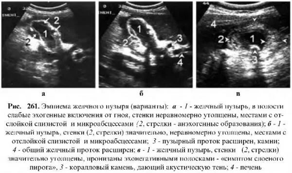 Дифференциальная диагностика водянки и эмпиемы желчного пузыря. Эмпиема желчного пузыря на УЗИ. Эмпиема желчного пузыря УЗИ картина. УЗИ картина водянки желчного пузыря.