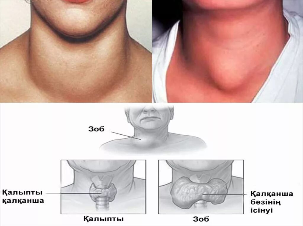 Щитовидная железа тиреомегалия. Узловой эндемический зоб. Эндемический зоб как выглядит.