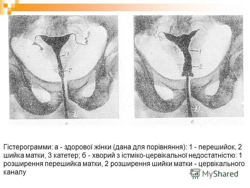 Цервикальный канал 1