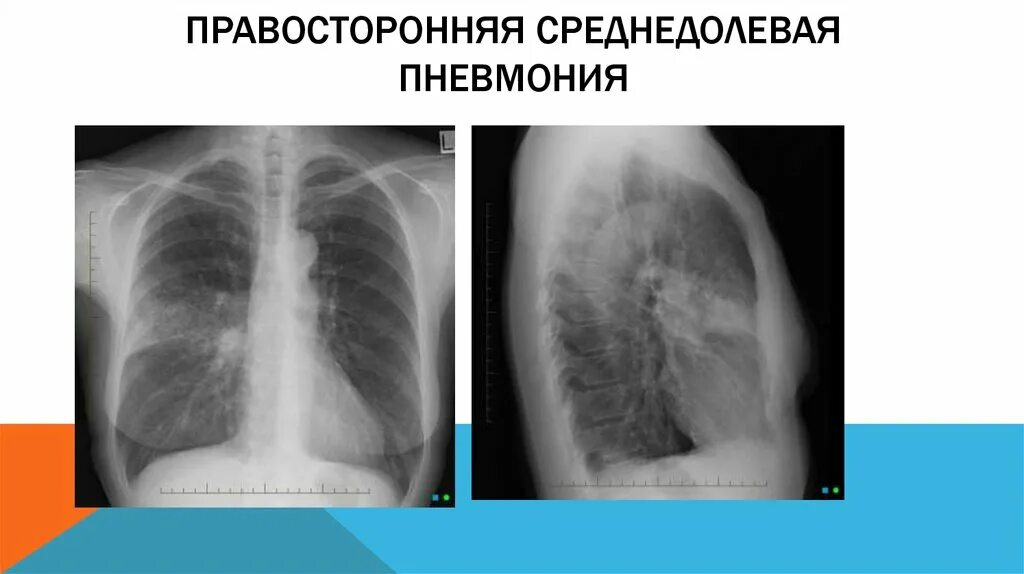 Пневмония в правой нижней доле. Правосторонняя нижнедолевая очаговая пневмония рентген. Рентген левосторонняя крупозная пневмония. Крупозная пневмония рентгенограмма. Долевая крупозная пневмония рентген.