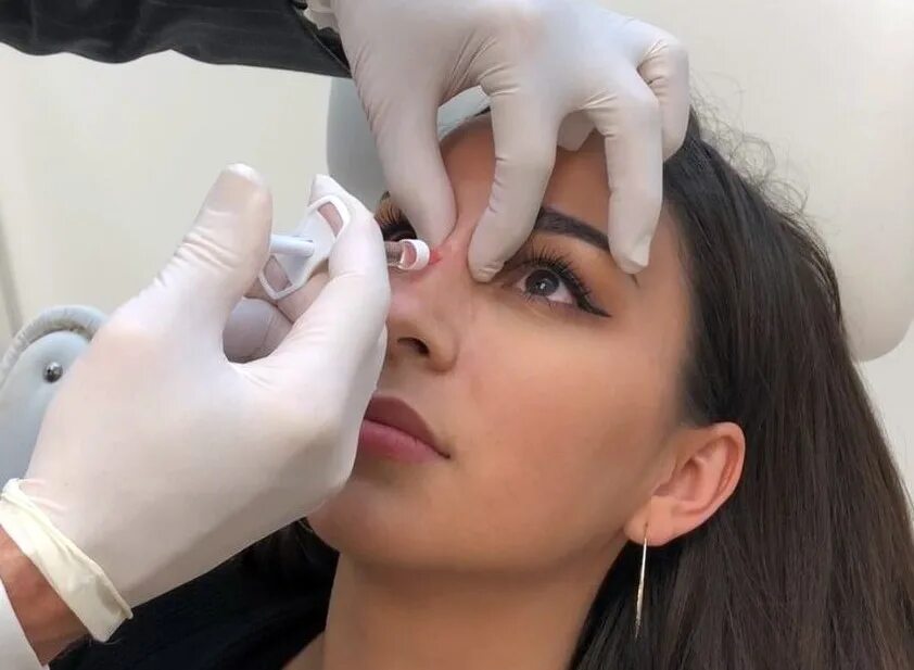 нос с помощью филлера. схема коррекции носа филлерами. пластика кончика носа. нос с помощью филлера. аугментационная ринопластика.