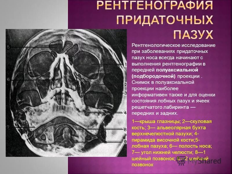 околоносовые пазухи и гайморовы пазухи. кт околоносовых пазух в аксиальной и коронарной проекциях. что такое рентген пазух носа 1 проекция. пазухи решетчатого лабиринта строение носовой полости. проекции придаточных пазух носа.
