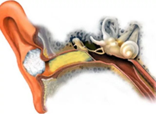 Тубоотит симптомы и лечение