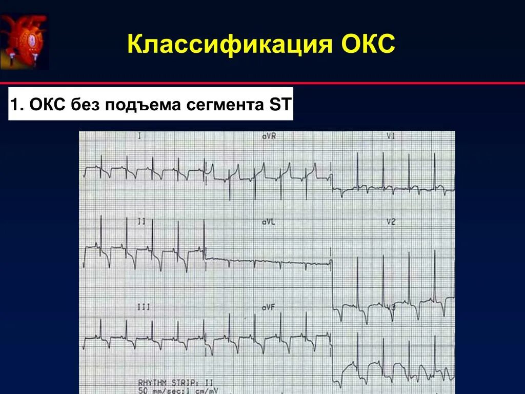 Острый коронарный синдром инфаркт. Окс с подъемом сегмента St ЭКГ. Окс без подъема St на ЭКГ. Острый коронарный синдром без подъема сегмента St ЭКГ. Инфаркт миокарда с подъемом сегмента ст ЭКГ.