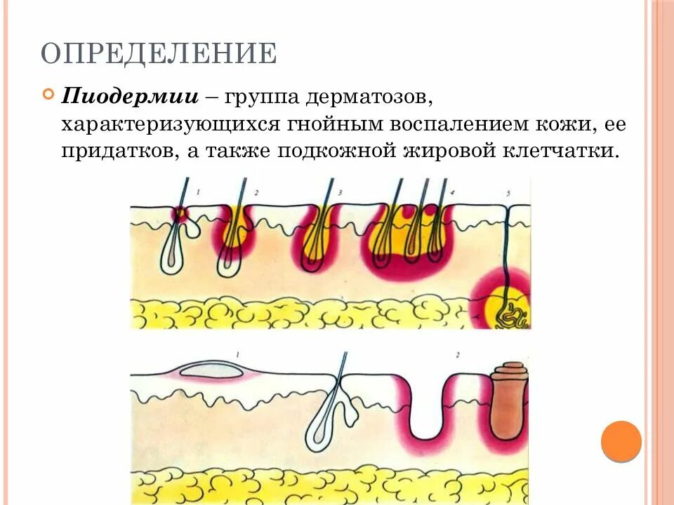 Пиодермия в ребенке иллюстрация вектора. иллюстрации насчитывающей заразно - 128