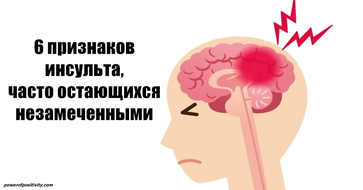 Признаки головного инсульта. Инсульт. Признаки инсульта. Инсульта головного мозга у женщин.